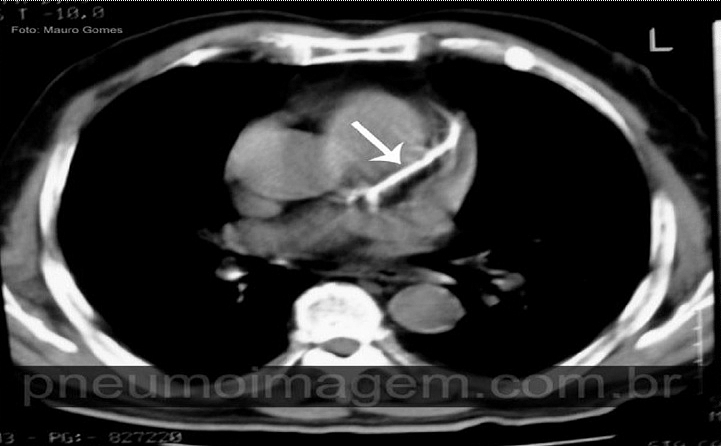 AVALIAÇÃO VISUAL DE CALCIFICAÇÃO NAS CORONÁRIAS PODE INDICAR RISCO DE DOENÇA CORONARIANA AVALIAÇÃO VISUAL DE CALCIFICAÇÃO NAS CORONÁRIAS PODE INDICAR RISCO DE DOENÇA CORONARIANA